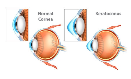 Normal Cornea and Keratoconus (KC) Cornea.のイラスト素材