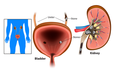 Nephrolithiasis kidney stones or urolithiasis. Renal Calculus or Stones blocking the urinary tract.のイラスト素材