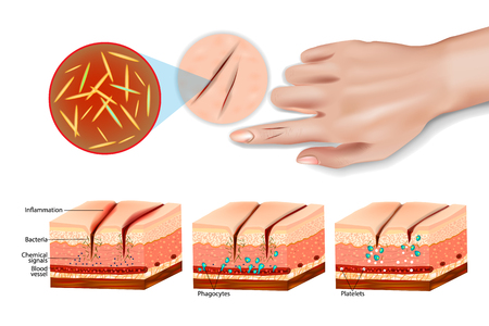 Tissue injury and inflammation. Cell injury inflammation and repair. Immune systemのイラスト素材