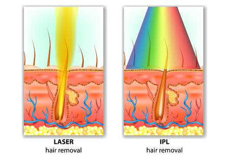 IPL (Intense Pulsed Light) and Laser Hair Removal. Hair Removal Differencesのイラスト素材