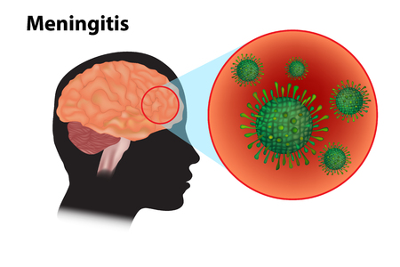 Meningitis - inflammation of the brain. Viral meningitis and encephalitisのイラスト素材