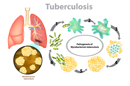 Tuberculosis (TB). Progression of pulmonary tuberculosis - Mycobacterium tuberculosis (MTB) bacteriaのイラスト素材