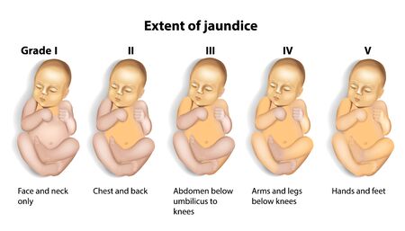 Extent of Jaundice (icterus) with Babyのイラスト素材