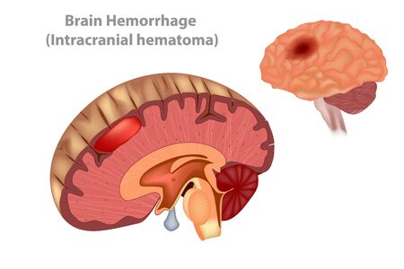 Brain Hemorrhage (Intracranial hematoma) Vectorのイラスト素材