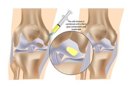 Stem cell therapy (Injections) for repair of knee cartilage. The cell mixture is combined with a fibrin glue component and implanted.のイラスト素材