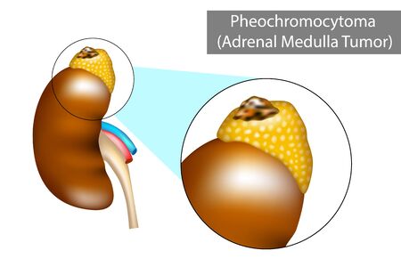 Pheochromocytoma (PH or PCC). Adrenal gland tumorのイラスト素材