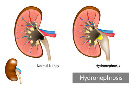 Hydronephrosis. Hydrostatic dilation of the renal pelvis and calycesのイラスト素材