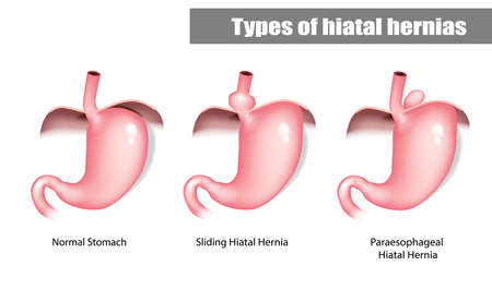 Types of hiatal hernias sliding and paraesophageal. Abdominal organsのイラスト素材