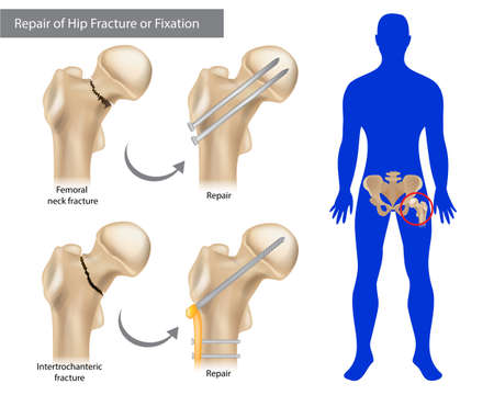 Repair of Hip Fracture or Fixation. Intertrochanteric fracture or Femoral neck fracture.のイラスト素材