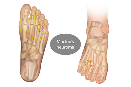 Morton neuroma, Mortons metatarsalgia, Intermetatarsal neuroma, and Intermetatarsal space neuroma.のイラスト素材