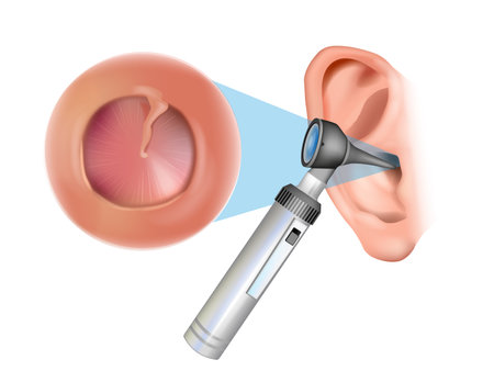 Ear examination with an otoscope. Otitis media with effusion: serous otitis media, secretory otitis media. Iinflammation of the eardrum. Otorhinolaryngologyのイラスト素材