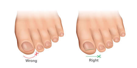 How to cut toenails correctly vector illustration. Proper and improper trimming of nails.Ingrown Toenails. Pedicureのイラスト素材