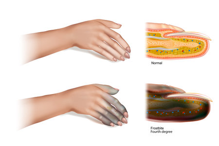 Frostbite Fourth degree. Skin injury that occurs when exposed to extreme low temperatures, causing the freezing of the skin or other tissues.のイラスト素材
