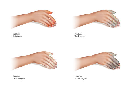 The four frostbite stages.Skin injury that occurs when exposed to extreme low temperatures, causing the freezing of the skin or tissues.のイラスト素材