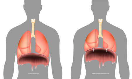 Normal diaphragm or Diaphragmatic event. Abnormal elevation of a portion or entire hemidiaphragm. Paralysis of the diaphragmのイラスト素材