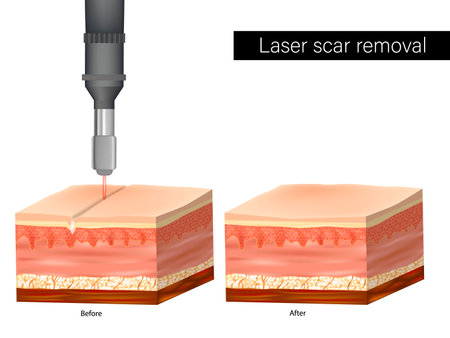 Laser scar removal. Before and After. Scar Treatment. Laser Scar Reduction.のイラスト素材