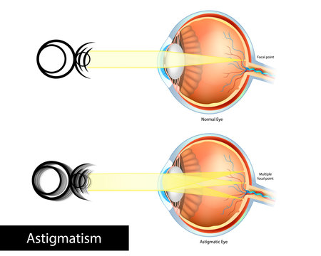 Astigmatic Eye and Normal Eye. Astigmatism, refractive or refraction error. Blurred, or distorted vision. Multiple focal pointのイラスト素材