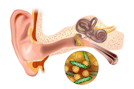 Bacterial ear infection. Ear infection middle ear. Streptococcus pneumoniae and Haemophilus influenzaeのイラスト素材