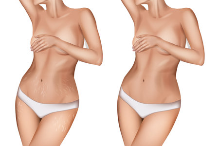 Stretch marks, also known as striae or striae distensae. Striae are caused by tearing of the dermis. Before and Afterのイラスト素材