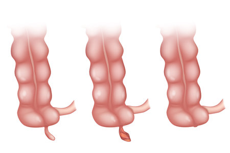 Appendicitis is an inflammation of the appendix. is an inflammation of the appendix. Appendicitis Treatment Surgery. Appendectomy. Laparoscopic Appendix Removalのイラスト素材