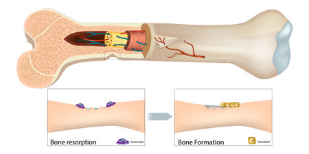 Human Bone Remodeling Illustration with Osteoclasts and Osteoblasts. Long Bone Cross Section Showing Resorption and Formation Stagesのイラスト素材