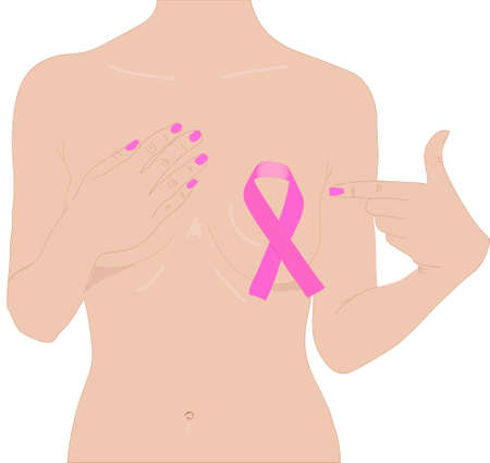 A closeup of a pink badge ribbon on a woman's breast to support the cause of breast cancer. Health care, medicine and breast cancer awareness concept.のイラスト素材