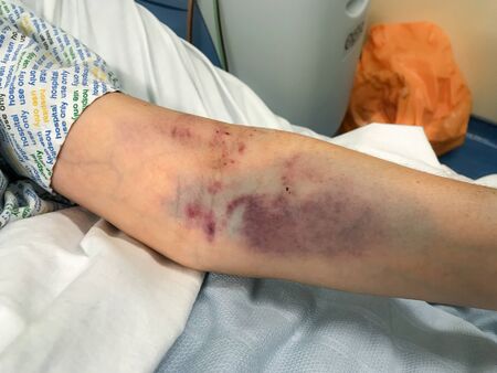 A close up of a woman's arm badly bruised from several attempts at drawing blood, the edge of the...