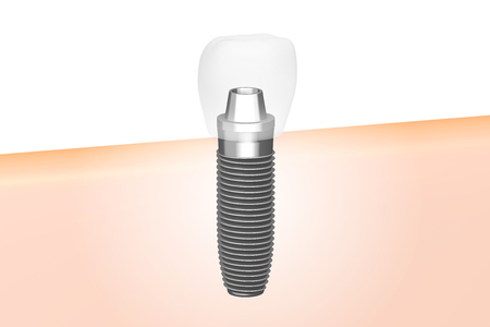 Dental implant/ tooth implantの写真素材