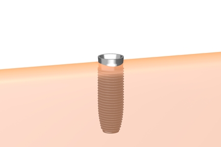 Dental implant/ tooth implantの写真素材