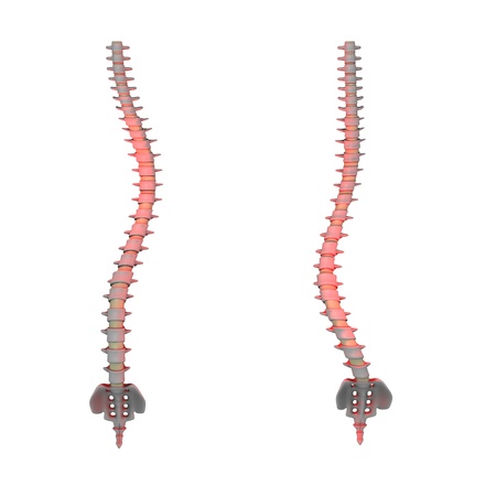 3d render of spine scoliosisの写真素材