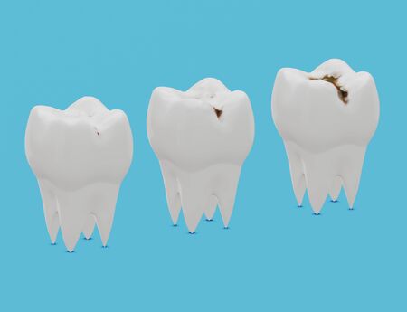 Three stages of tooth decay, caries. 3d illustrationの写真素材