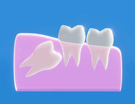Wisdom tooth grows wrong, wisdom tooth problem, horizontal position of the wisdom tooth, Impacted wisdom tooth. 3d illustrationの写真素材