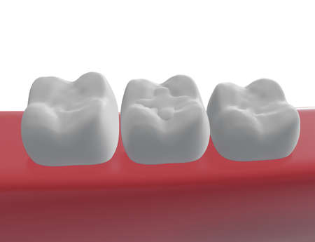 three molar teeth in the gum, polymer filling of a tooth in the middle, 3d renderの写真素材
