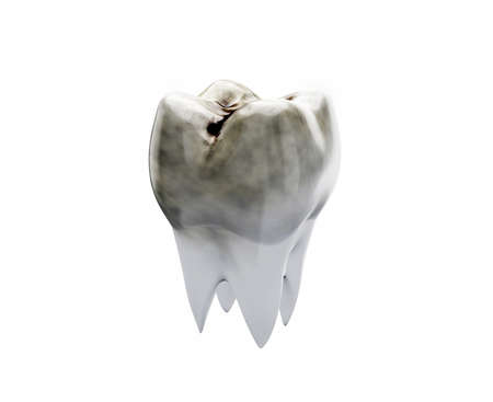 One dirty molar tooth, tooth decay, caries. 3d illustrationの写真素材