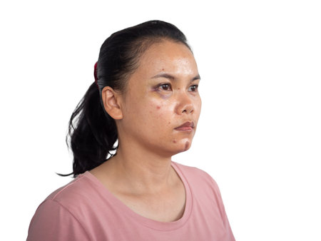 Woman face bruised due to surgery.の写真素材