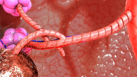 Granuloma