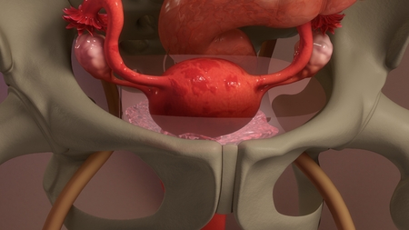 Endometriosisの写真素材