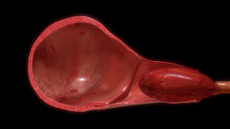 Pulling placenta out of uterus