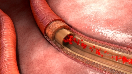 Blood flow in vessels