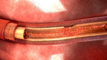 Artery Dissection topの写真素材