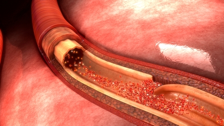 Artery Dissection perspectiveの写真素材