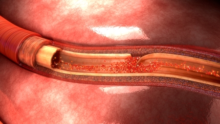 Artery Dissection frontの写真素材