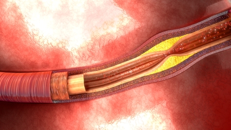 Atherosclerosis aerialの写真素材