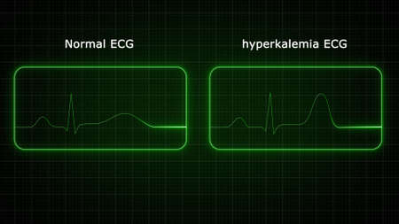 Electrocardiogram on a green background. Vector illustration.の写真素材