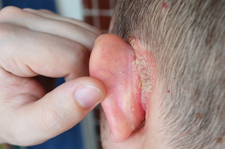 Psoriasis behind the ear, pushes the ear, dermatological problems, skin diseases