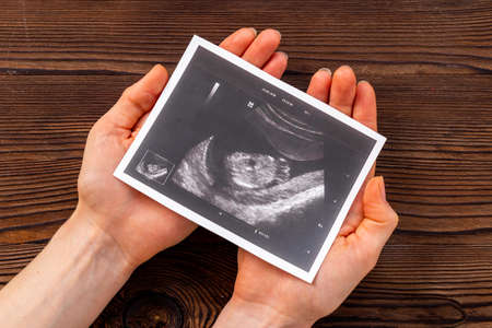 Sonography pregnancy picture of embryo in wonams handsの写真素材