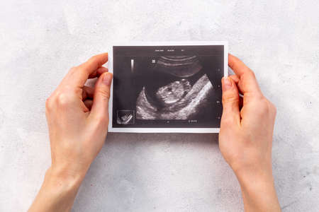 Sonography pregnancy picture of embryo in wonams handsの写真素材