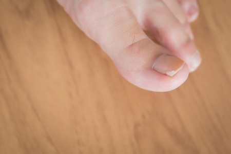 woman toe with broken nailの写真素材