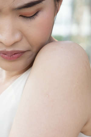 Asian woman getting vaccinated immunity with keloid scar on her upper arm, concept of universal vaccine rollout plan, inoculation, vaccination, adverse effect of side effect of vaccineの写真素材