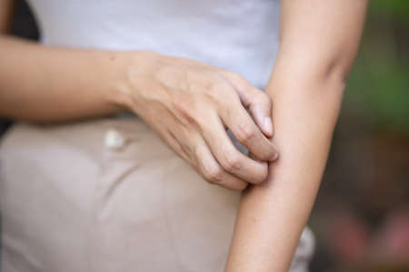 Asian woman scratching her arm skin, concept of dry skin, allergic dermis inflammation, fungus infection, dermatology disease, eczema, rash, skin careの写真素材